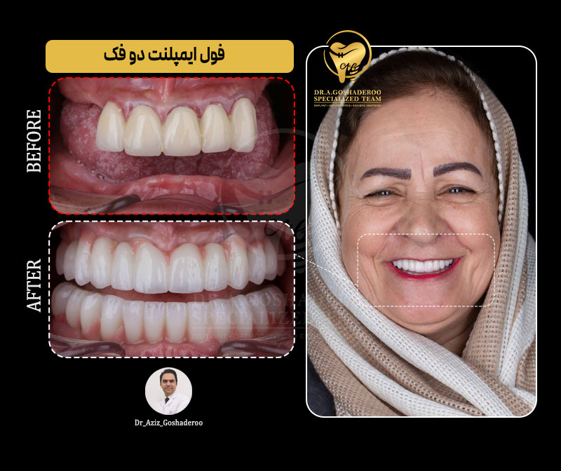 فول ایمپلنت دو فک